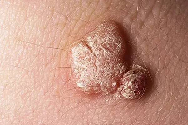 Signs of HPV