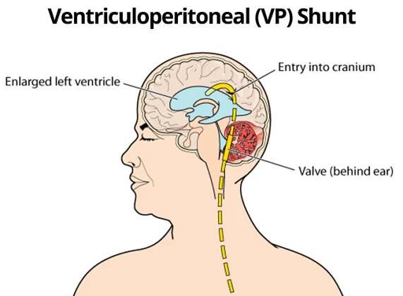 Ventriculoperitoneal (VP) Shunt diagram