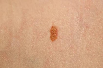 Nevus nebo melanom na kůži člověka zblízka �— Stock obrázek