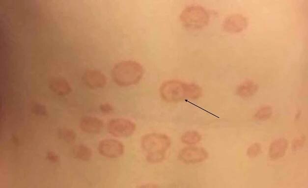 Tinea Versicolor: Common Skin Disease - Health Blog