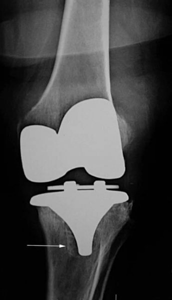 Left TKA 6.5 years after surgery