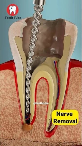 Root Canal Treatment 3D Animation #shorts