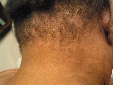 follicular mucinosis associated with mycosis fungoides