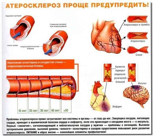 Příznaky infarktu myokardu, diagnóza, metody léčby a nouzová péče o infarkt / Kardiologie | Užitečné informace a tipy na