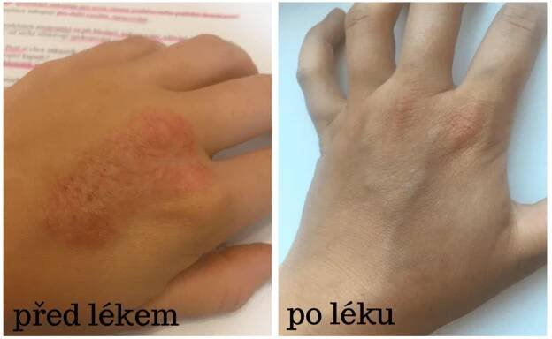 Atopický ekzém, alergie a bolesti ramene (žena, 26 let)