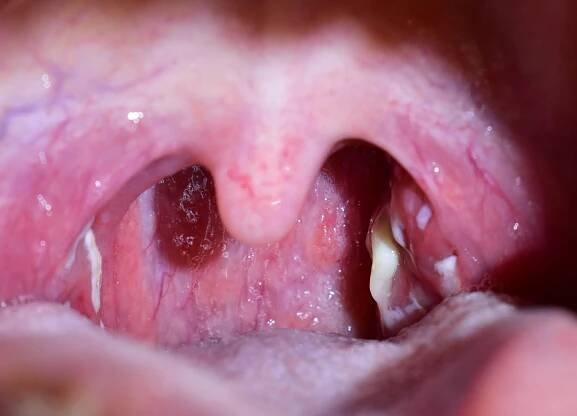 Tonsillitis.,Pus,On,The,Tonsils