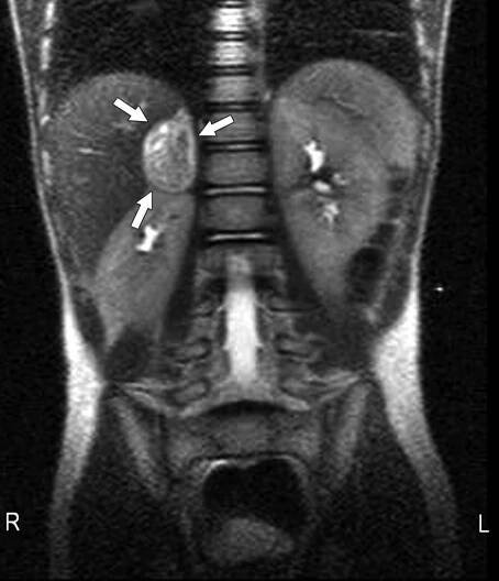 jak-se-projevuje-feochromocytom-nador-nadledviny-priznaky-projevy-symptomy-4