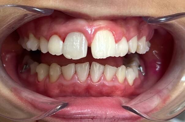 DENTÁLNÍ HYGIENA | Ortodoncie MUDr. Hana Benešová 
