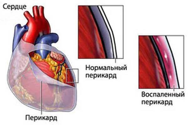 Perikarditida, co to je? Symptomy a léčba / Perikarditida | Užitečné informace a tipy na péči o sebe. Zdraví, výživa a další