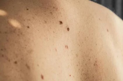 Zblízka detail holé kůže na člověku, který se rozházeným mosem a pihami. Kontrola neškodných krtků — Stock fotografie