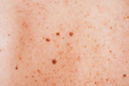 Blízko nemocné ženy melanom na nemocné kůži — Stock obrázek