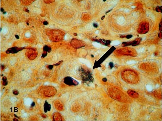 Bartonella quintana