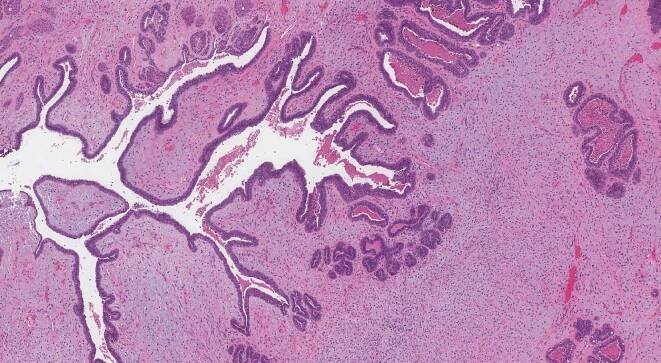Borderline phyllodes tumor prsu