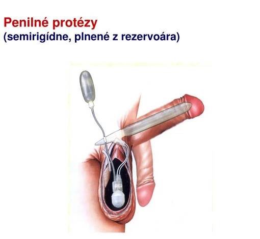 PPT - Vplyv rakoviny prostaty na sexualitu PowerPoint Presentation, free download - ID:565641