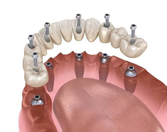 Mandibulární protéza Vše na 4 systém podepřený implantáty, šroubovací fixace. Lékařsky přesná 3D ilustrace zubní koncepce — Stock obrázek
