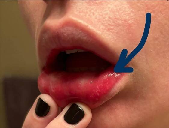 50 Facts About Herpangina