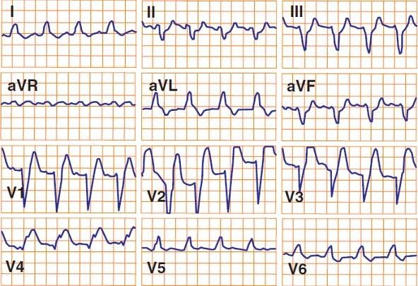 ECG sgarbossa criteria, STEMI and LBBB, Concordant ST elevation greater than 1mm, Excessively discordant ST elevation greater than 5 mm