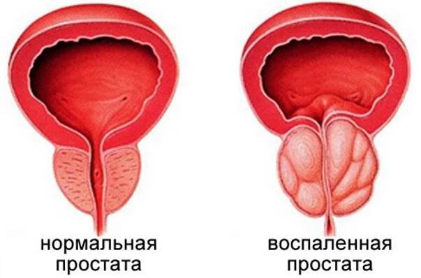 Včelí červ na prostatitidu: recepty, jak se léčit