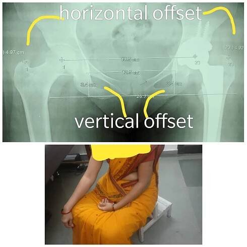 HIP REPLACEMENT