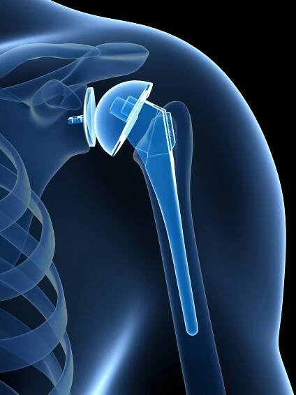 Shoulder Replacement - Space Coast Orthopedic