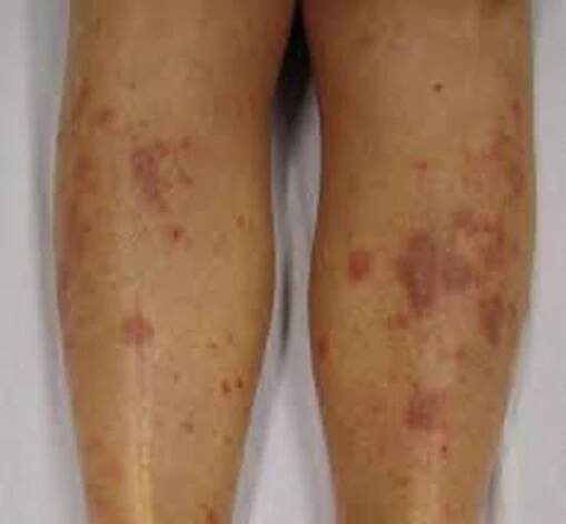 Eczema