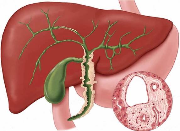 Primární sklerozující cholangoitída – příznaky, projevy, symptomy