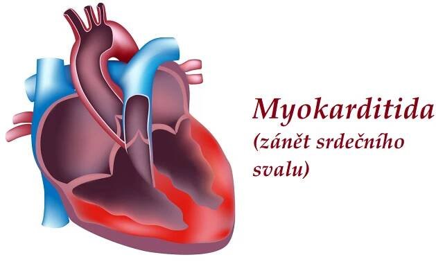 Myokarditida, zánět srdečního svalu – příznaky, projevy, symptomy, příčina, léčba