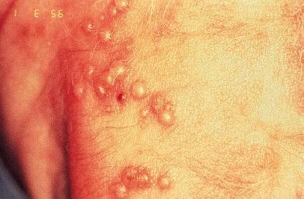 Herpes Simplex Virus (HSV) Infection in Newborns - Children's Health Issues - MSD Manual Consumer Version