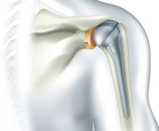 From Rotator Cuff Repair to Shoulder Replacement: Your Guide to Shoulder Surgery