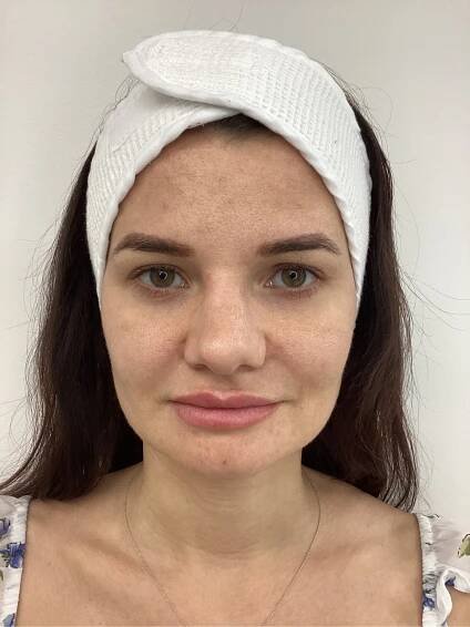 Before/Afters | GLANZ Aesthetics | Doral, FL
