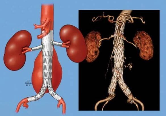 Onemocnění tepen a jejich léčba – Surgimed – estetická a cévní chirurgie, lasercentrum