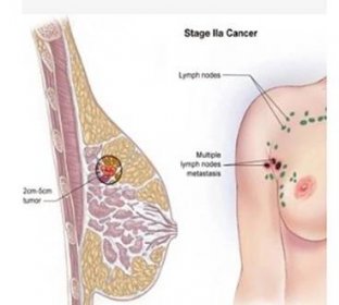 je léčena rakovina prsu 2. stupně