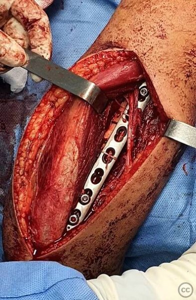 Humeral Shaft Fracture