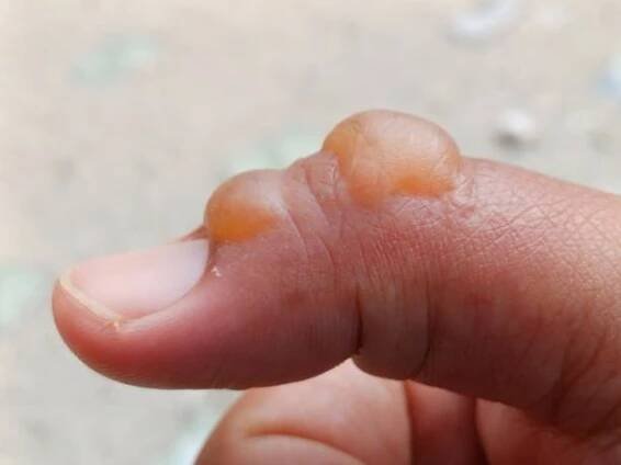 a blister on finger caused by a cooking oil burn is a common injury that can be painful and bothersome. - male dermatologist - stock snímky, obrázky a fotky