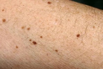 Nebezpečné nebo neškodné pigmentové skvrny na kůži — Stock obrázek