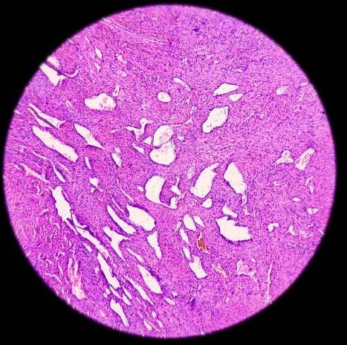 tkáň z prsteníčku: neurofibrom, typ benigního nádoru, neurofibromatóza - neurofibromatóza - stock snímky, obrázky a fotky