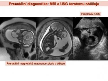 Prenatální USG. Prenatální magnetická rezonance plodu v děloze.