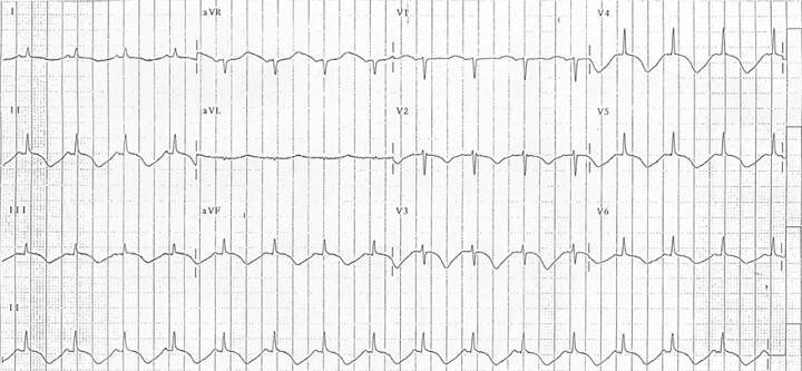 ECG acquired long QT syndrome, cerebral T waves, intracranial pressure, subarachnoid haemorrhage