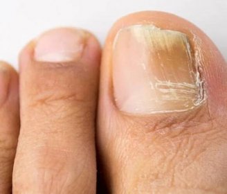 plísňová infekce nehtů na nohou