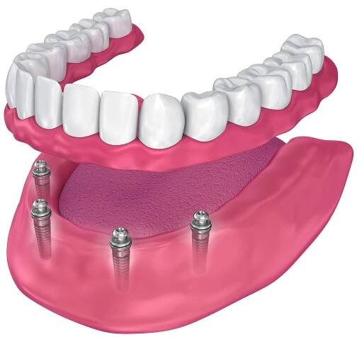 Protéza nesená implantáty. Zubní implantáty jsou zakončeny kulovými koncovkami, na které se hybridní náhrada „nacvakne“ – a v ústech proto lépe drží. 