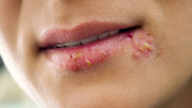Opary – herpes