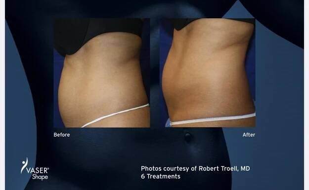 Body Contouring/ Fat & Cellulite Reduction | BeautyPros Permanent Cosmetic & Medspa LLC