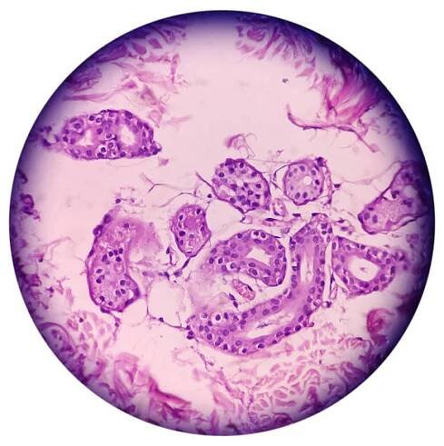 kožní tkáň (biopsie): pityriasis lichenoids chronica, skupina vzácných získaných zánětlivých kožních onemocnění. epidermis vykazují mírnou hyperkeratózu a akantózu, fokální exocytózu lymfocytů. - pityriasis - stock snímky, obrázky a fotky