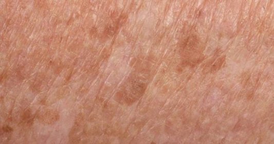 Únava, časté infekce a skvrny na kůži – i to jsou první signály leukemie
