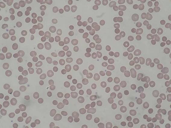 Hereditární sférocytóza – WikiSkripta