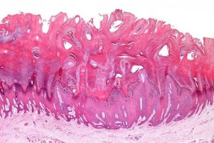 kondyloma genitální bradavice