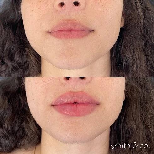 filler — Miami Beach Botox Specialist
