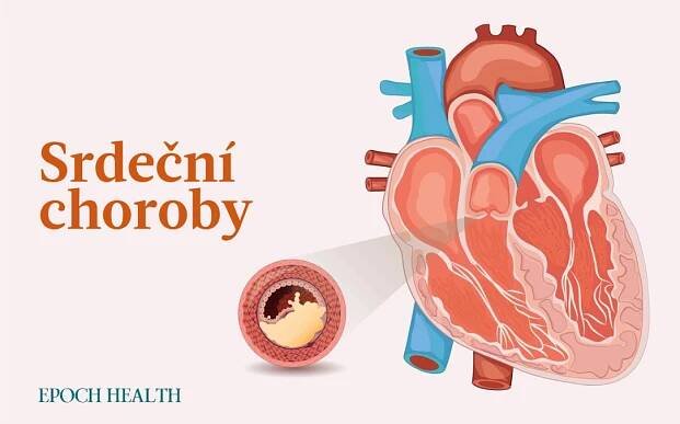 Srdeční choroby: Příznaky, příčiny, léčba a další řešení