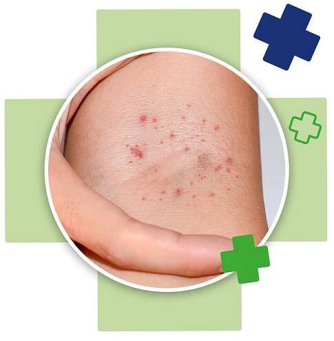 Meningitida neboli zánět mozkových blan | BENU.cz 
