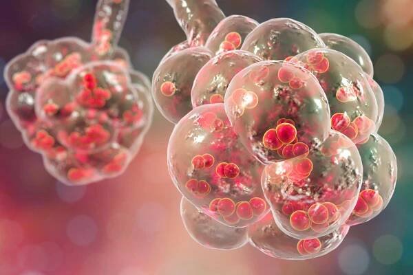 Pneumokoková pneumonie, lékařská koncepce. 3D ilustrace zobrazující bakterie Streptococcus pneumoniae uvnitř alveoli — Stock obrázek